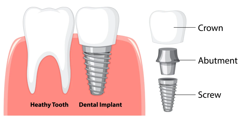 Dental Implant Fails