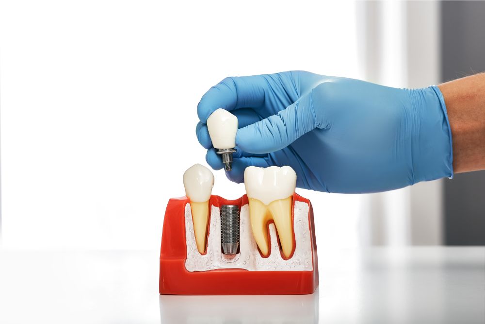 Implant teeth during pregnancy