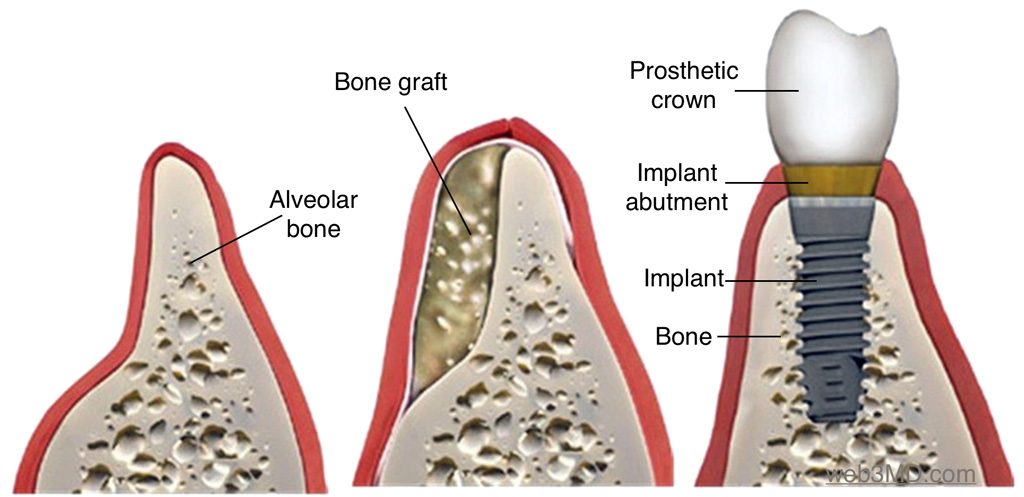 bone graft surgery