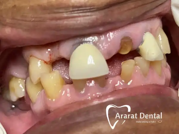 Implant placement & restoration! Patient has full dentition now!!