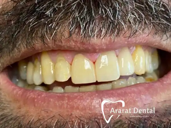 Same day smile enhancement with composite fillings