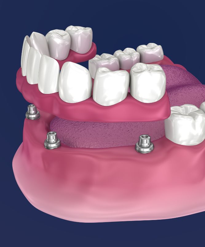all on four and all on 6 dental implants
