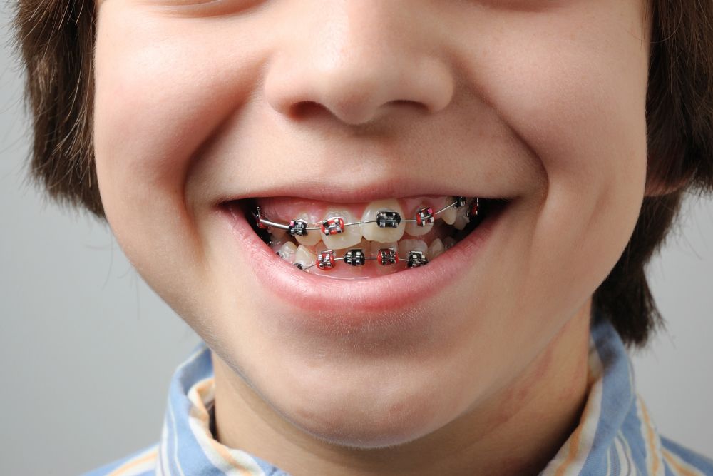 How Much Do Braces Cost in New Jersey