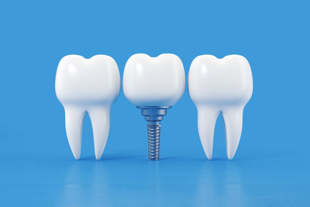 Are Dental Implants Worth Having