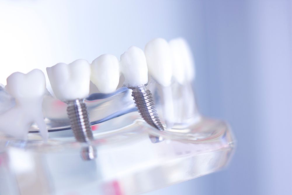 Are Dental Implants Worth Having