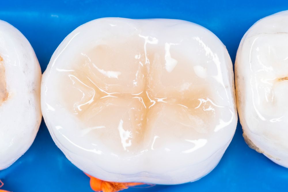 Modern Dental Restorations: The Rise of White Fillings
