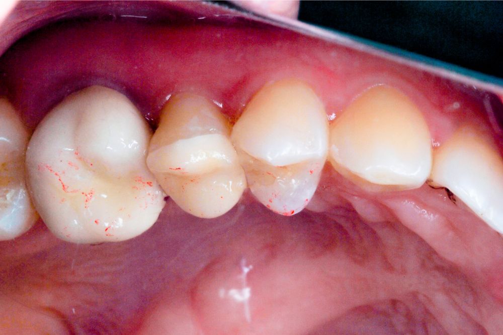 Modern Dental Restorations: The Rise of White Fillings
