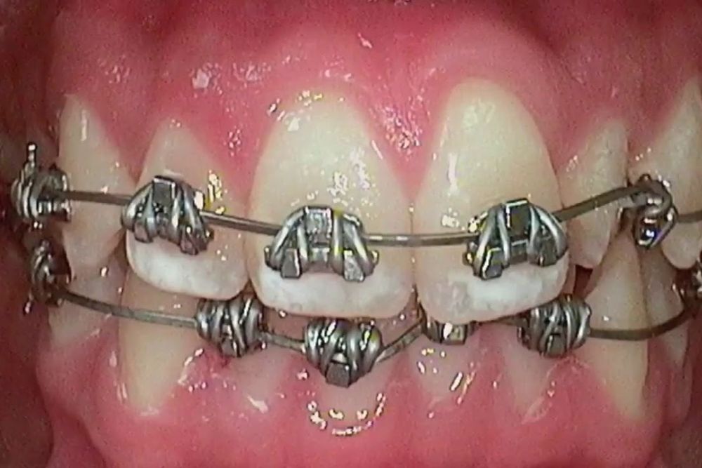 Fast Braces