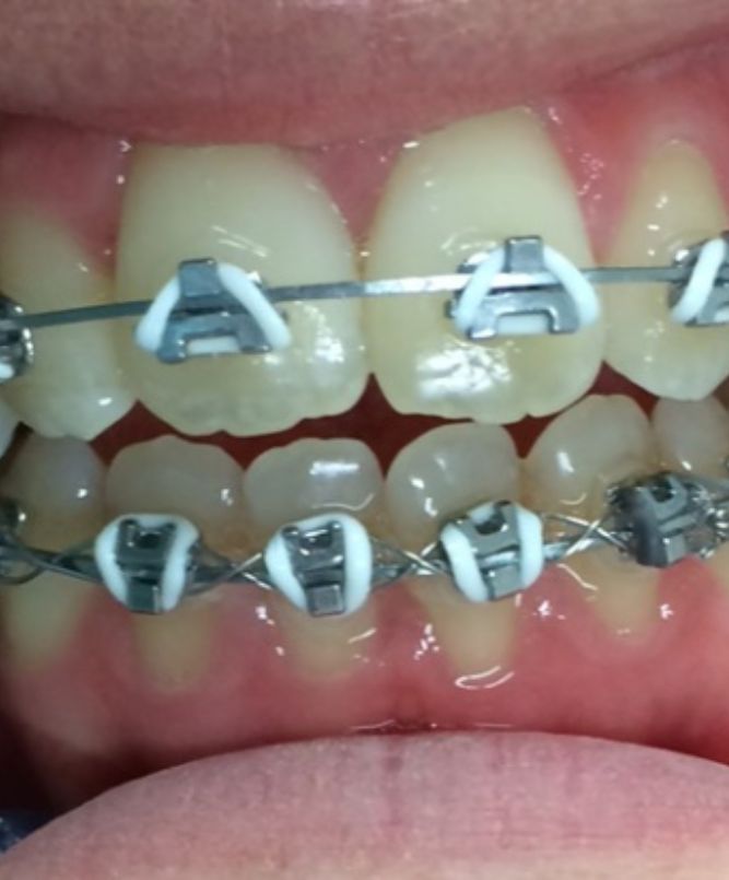 Fast braces for efficient teeth straightening