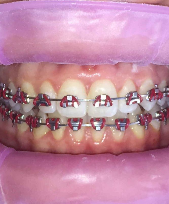 teeth with fast braces treatment