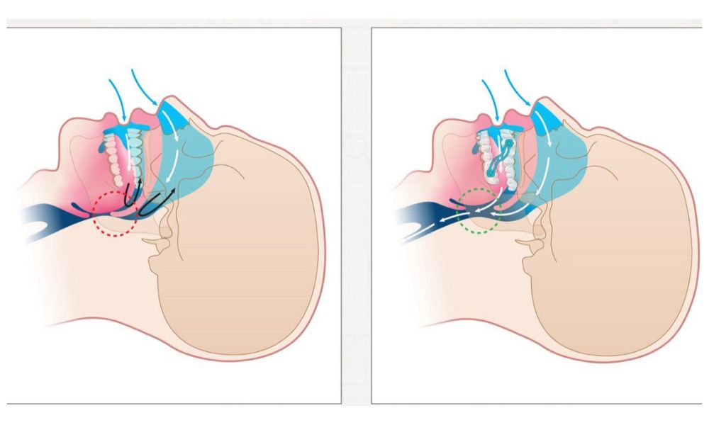 Sleep Apnea & Snoring Device