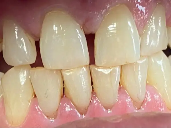 Tobacco stains removed after a professional Dental cleaning