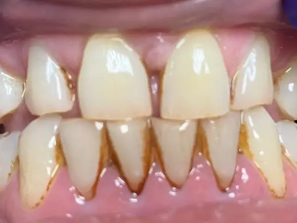 Tobacco stains removed after a professional Dental cleaning