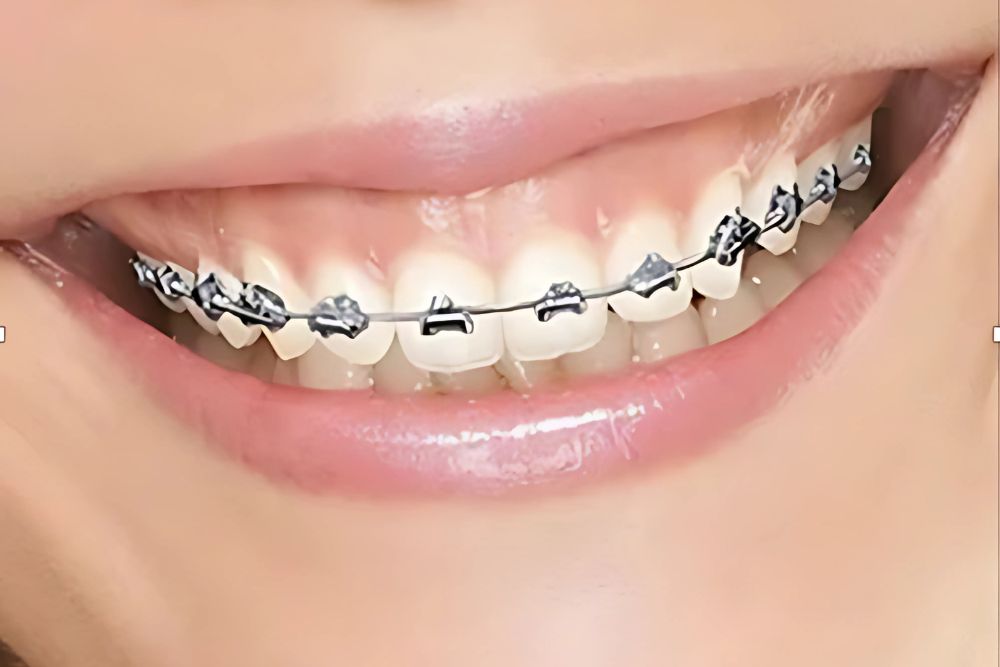 fast braces price