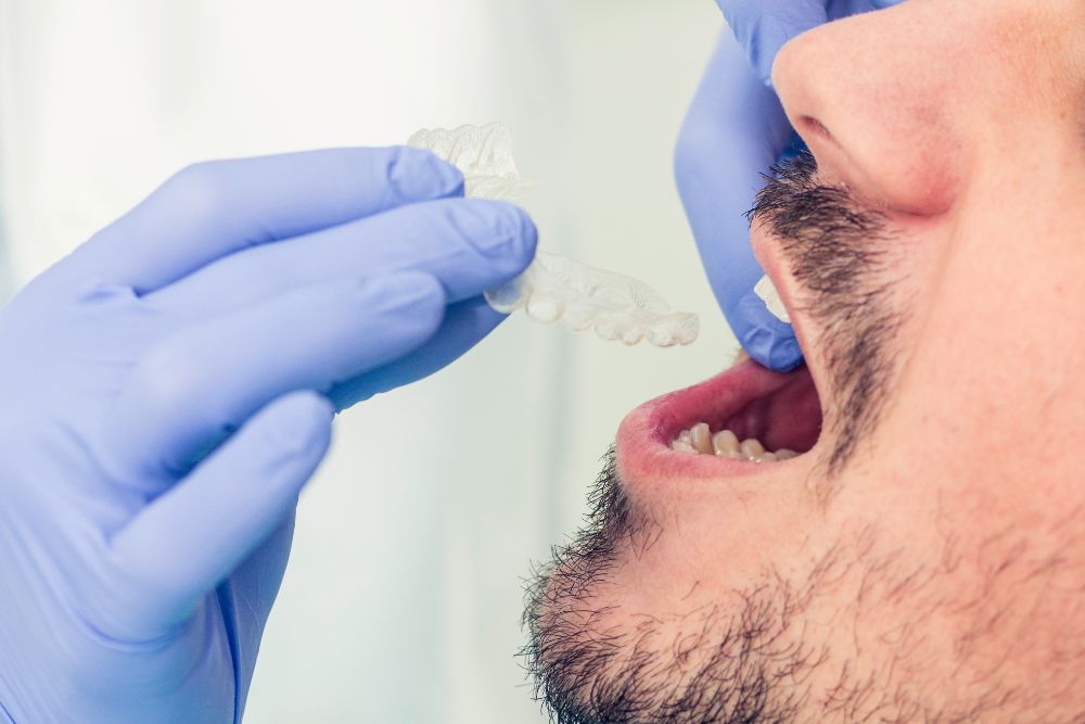 Affordable Invisible Braces: Can Invisalign Fix Malocclusions?