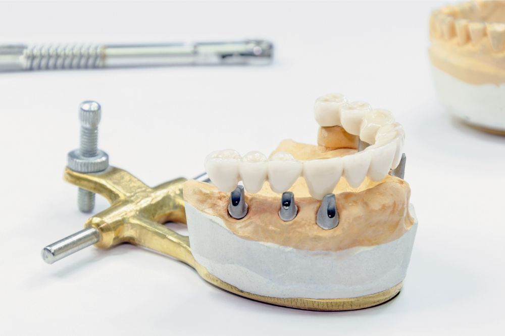 All-On-6 Dental Implants