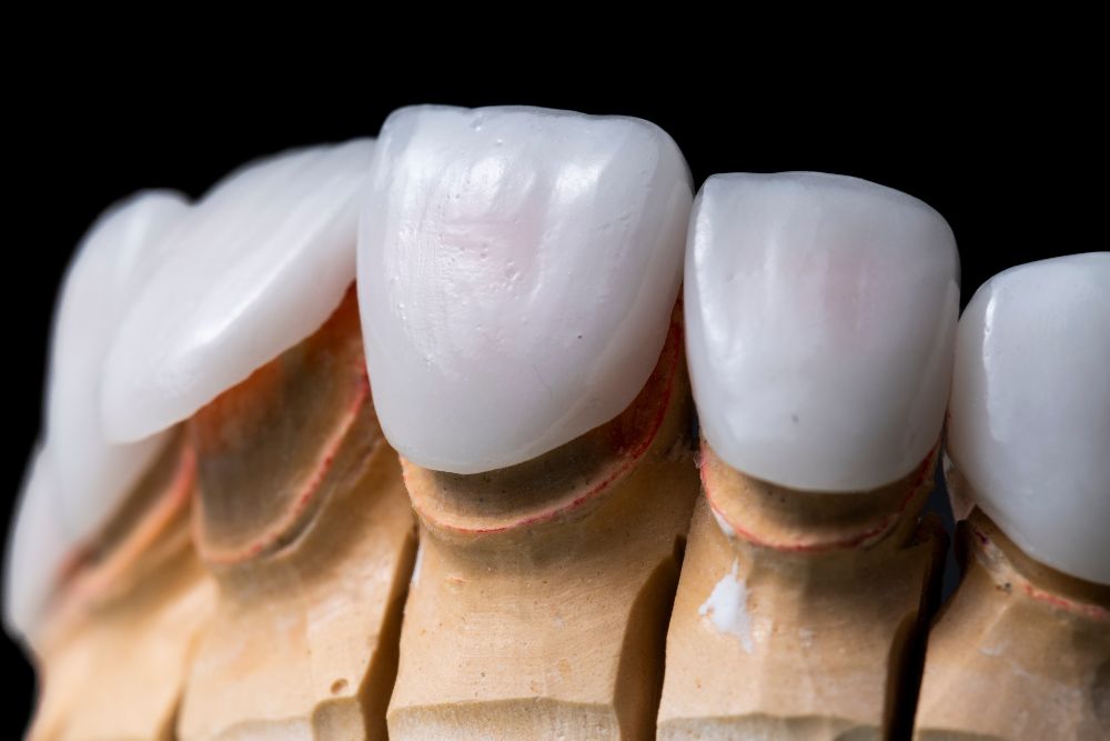 Are Veneers Worth the Money?