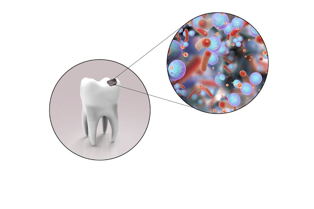 Is a Rotten Tooth a Dental Emergency