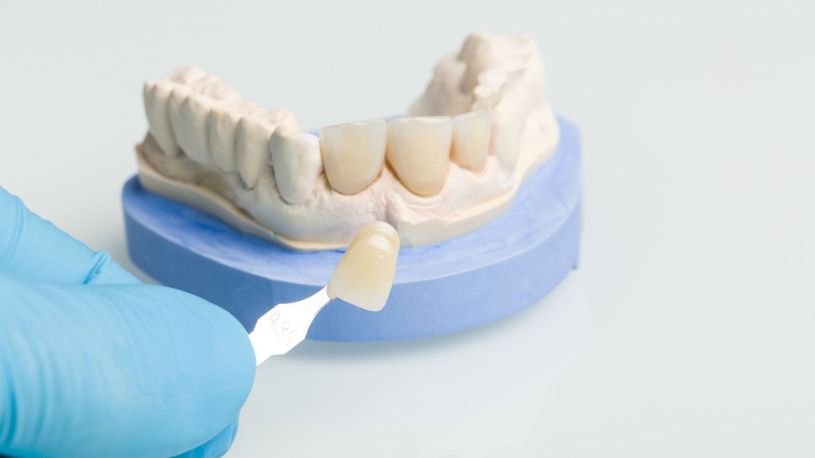 Dental Crowns in New Jersey: Enhance Your Smile with the Best Dentist