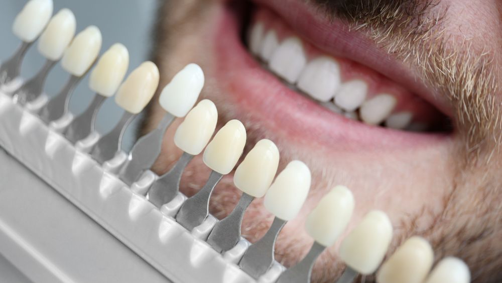 Porcelain Veneers