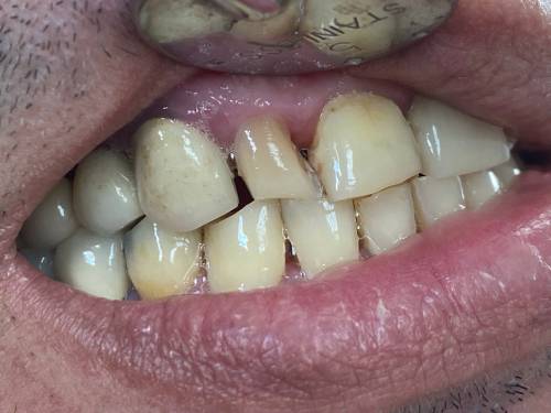 Composite Veneers in Jersey City