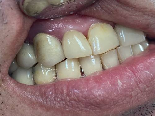 Composite Veneers in Jersey City