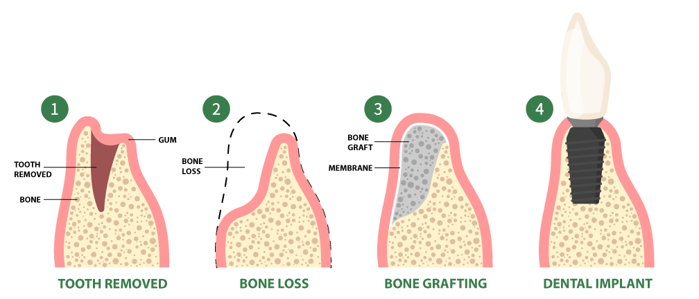 Bone Grafting in Jersey City