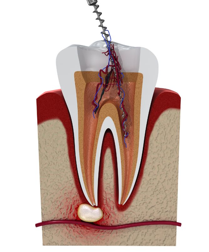 cavity repair cost