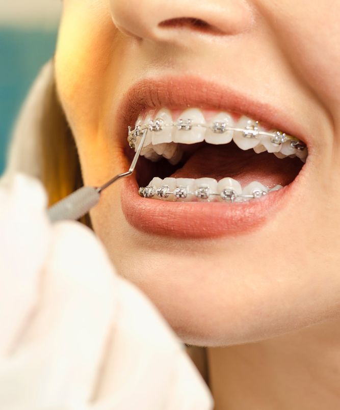 Adult Orthodontics