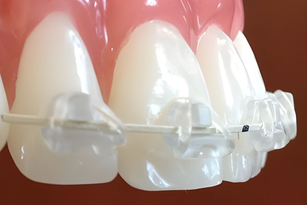 Fast Braces in Jersey City: A Faster Way to Straighten Your Smile