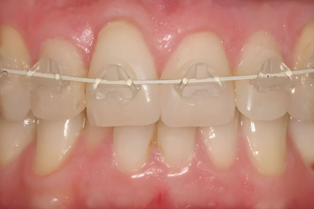 Fast Braces in Jersey City: A Faster Way to Straighten Your Smile