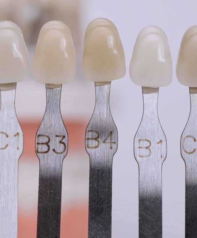 Composite veneers
