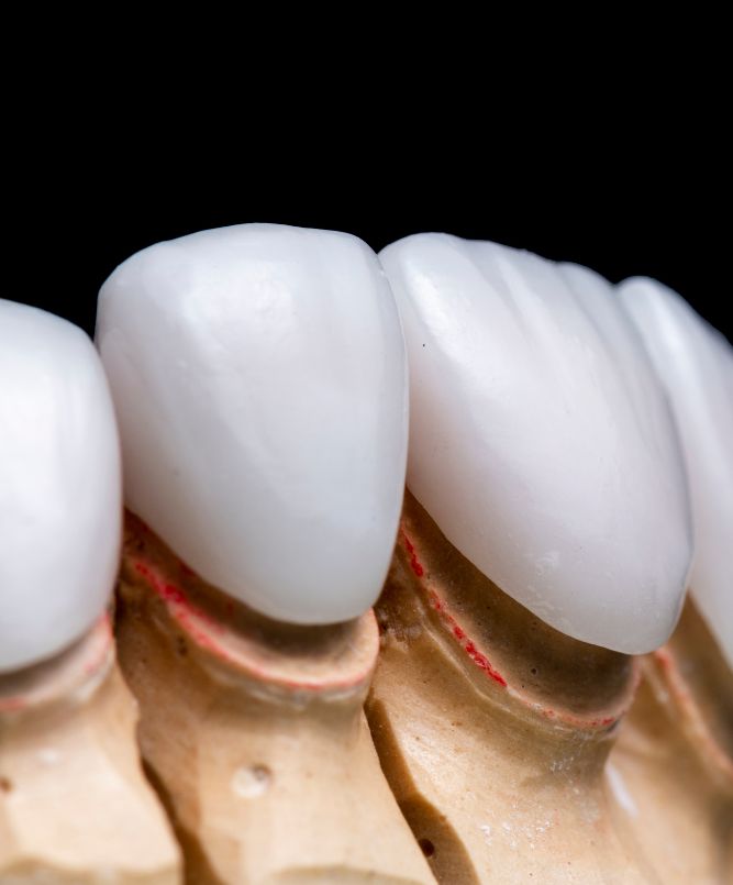 Composite veneers