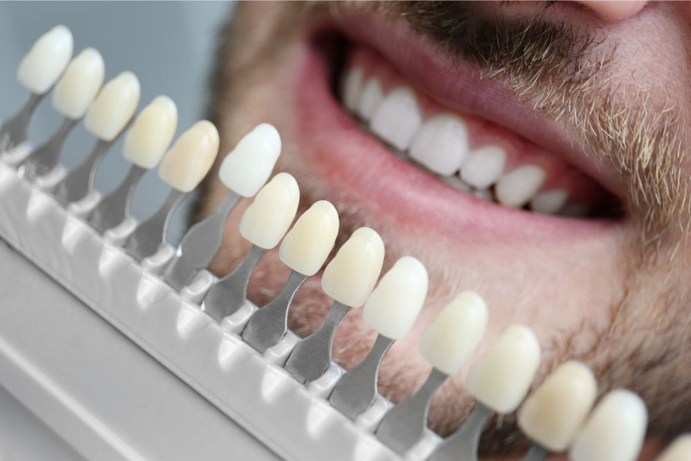 A before-and-after smile transformation displaying high-quality dental veneers at Ararat Dental in Jersey City