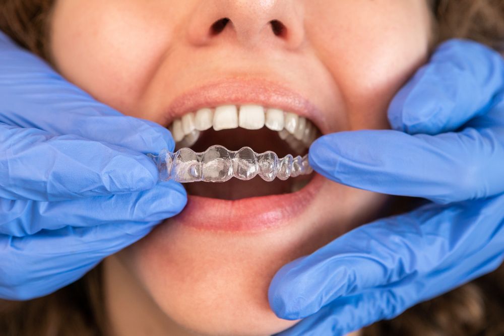 Veneers vs. Dental Aligners