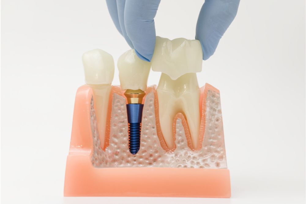 dental crowns jersey city