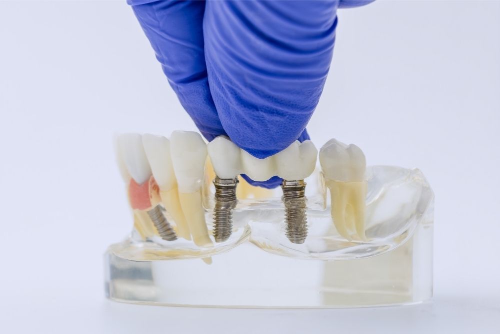 dental bridge jersey city