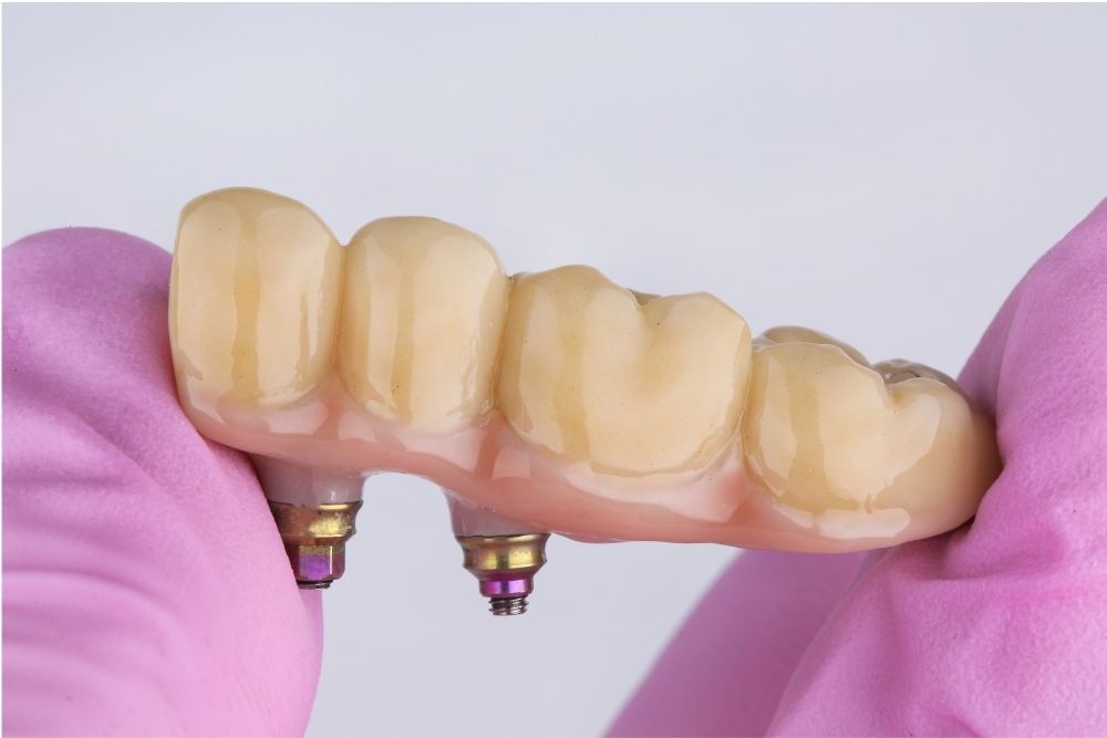 dental bridge jersey city