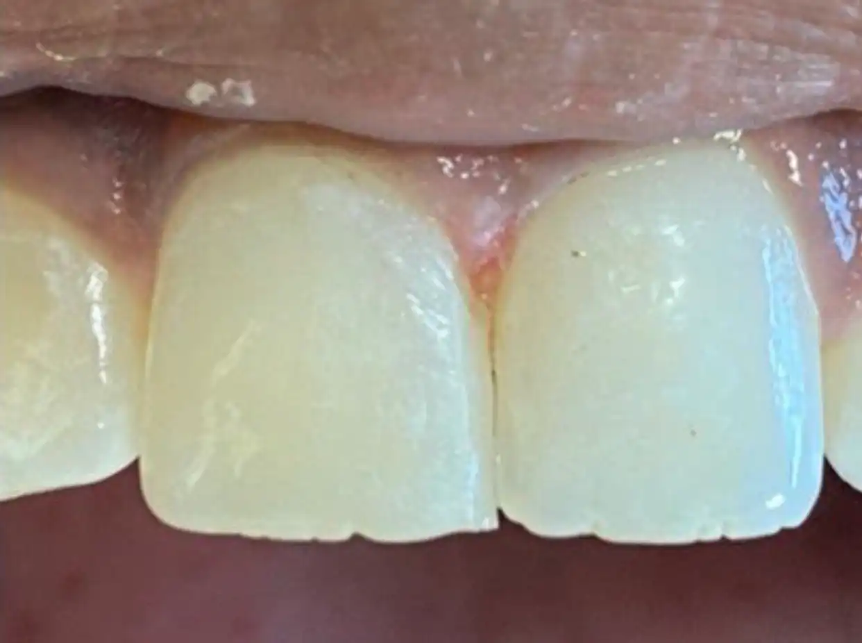 Cosmetic bonding to close spaces in 1 visit