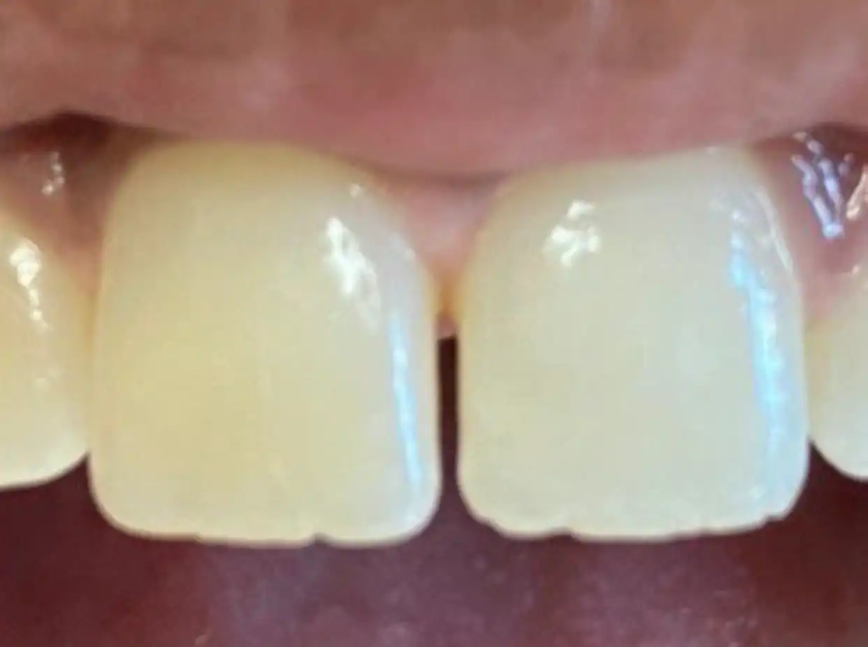 Cosmetic bonding to close spaces in 1 visit
