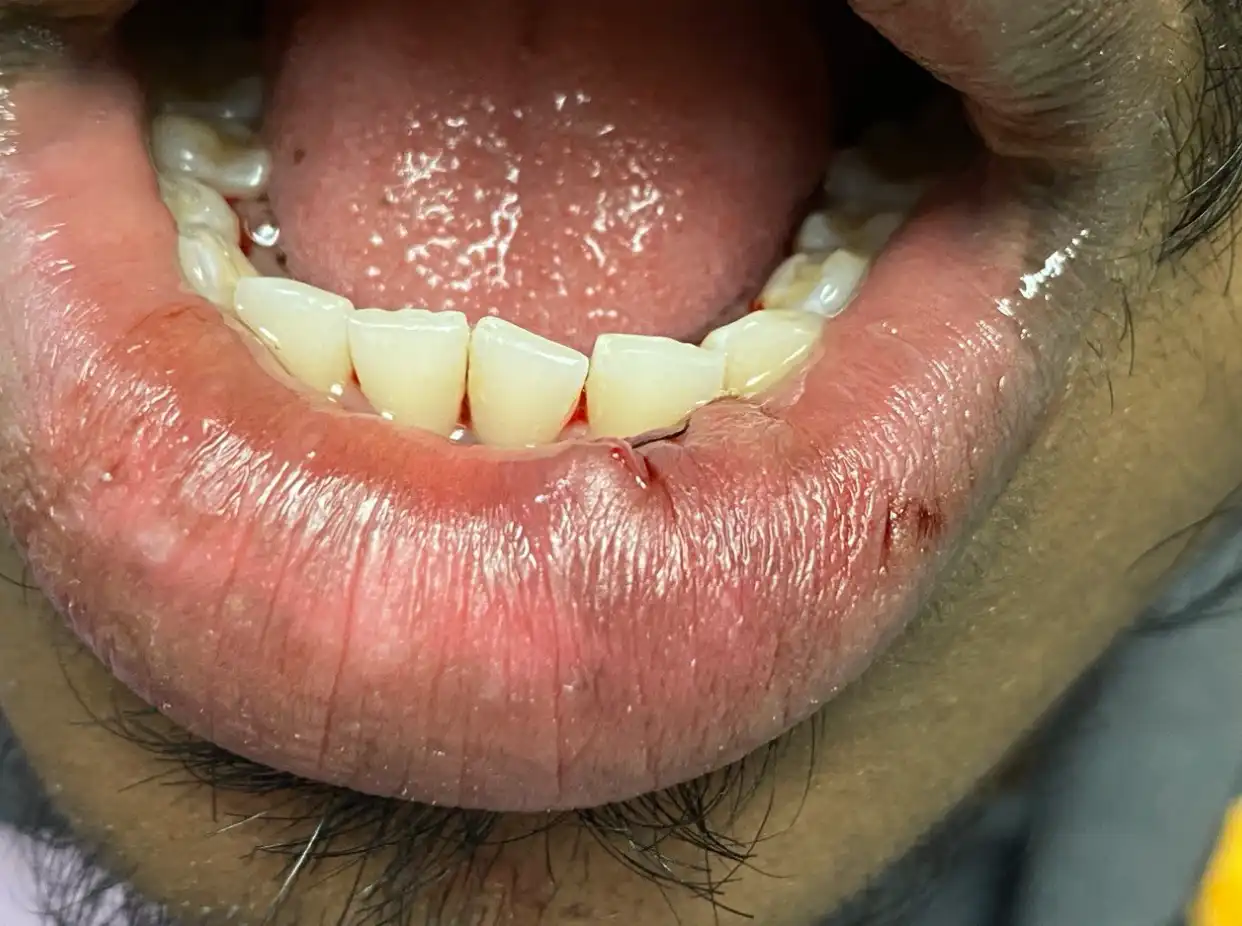 Mucocele removal, After