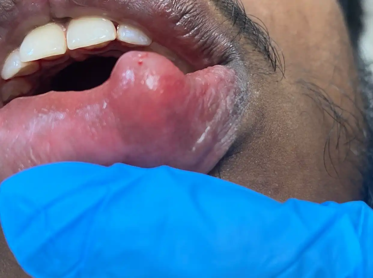 Mucocele removal, Before