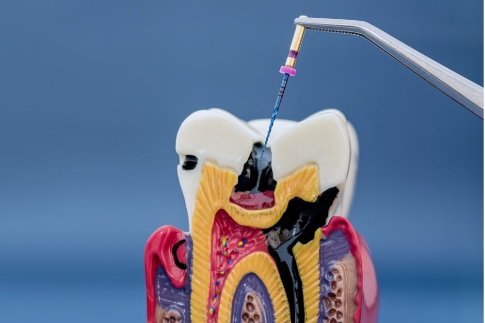 Root Canal Jersey City, NJ