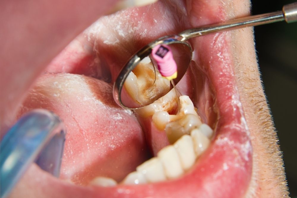 Root Canal Jersey City, NJ